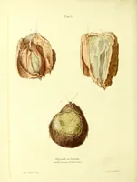 An illustration from Graphic illustrations of abortion and the diseases of menstruation. Consisting of twelve plates from drawings engraved on stone, and coloured by Mr. J. Perry, and two copperplates from the Philosophical transactions, coloured by the same artist. The whole representing forty-five specimens of aborted ova and adventitious productions of the uterus, with preliminary observations, explanations of the figures, and remarks, anatomical physiological / by A.B. Granville. (1834)