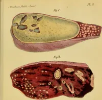 An illustration from Illustrations of pulmonary consumption, its anatomical characters, causes, symptoms and treatment. With twelve plates, drawn and coloured from nature / by Samuel George Morton. (1834)