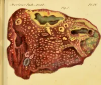 An illustration from Illustrations of pulmonary consumption, its anatomical characters, causes, symptoms and treatment. With twelve plates, drawn and coloured from nature / by Samuel George Morton. (1834)