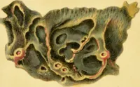 An illustration from Illustrations of pulmonary consumption, its anatomical characters, causes, symptoms and treatment. With twelve plates, drawn and coloured from nature / by Samuel George Morton. (1834)