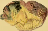 An illustration from Illustrations of pulmonary consumption, its anatomical characters, causes, symptoms and treatment. With twelve plates, drawn and coloured from nature / by Samuel George Morton. (1834)