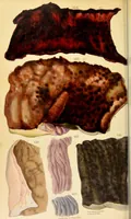 An illustration from Principles and illustrations of morbid anatomy : adapted to the elements of M. Andral, and to the Cyclopaedia of practical medicine, being a complete series of coloured lithographic drawings from originals by the author; with descriptions and summary allusions to cases, symptoms, treatment, &c. ... / by J. Hope. (1834)