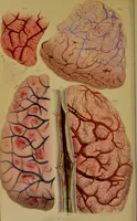 An illustration from Principles and illustrations of morbid anatomy : adapted to the elements of M. Andral, and to the Cyclopaedia of practical medicine, being a complete series of coloured lithographic drawings from originals by the author; with descriptions and summary allusions to cases, symptoms, treatment, &c. ... / by J. Hope. (1834)