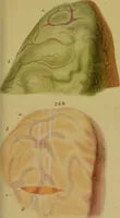 An illustration from Principles and illustrations of morbid anatomy : adapted to the elements of M. Andral, and to the Cyclopaedia of practical medicine, being a complete series of coloured lithographic drawings from originals by the author; with descriptions and summary allusions to cases, symptoms, treatment, &c. ... / by J. Hope. (1834)