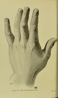 An illustration from The science of the hand, or, The art of recognising the tendencies of the human mind by the observation of the formations of the hands = la science de la main / translated from the French of C.S. D'Arpentigny and edited ... by Ed. Heron-Allen ; with original plates and explanatory diagrams by Rosamund Brunel Horsley. (1886)