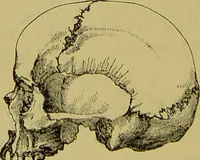 An illustration from Thesaurus craniorum : catalogue of the skulls of the various races of man, in the collection of Joseph Barnard Davis. (1867)