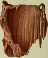 An illustration from Graphic illustrations of abortion and the diseases of menstruation / Consisting of twelve plates from drawings engraved on stone, and coloured by Mr. J. Perry, and two copper-plates from the Philosophical transactions coloured by the same artist : the whole representing forty-five specimens of aborted ova and adventitious productions of the uterus : with preliminary observations, explanations of the figures, and remarks, anatomical and physiological. By A. B. Granville. (1833)