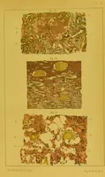 An illustration from Étude du processus histologique des néphrites / par Ch. Hortolès ; avec quatre gravures dans le texte et cinq planches chromolithographiées par M. Gouget. (1881)