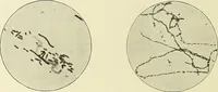 An illustration from Report on the bacteriological diagnosis and the antitoxic serum treatment of cases admitted to the hospitals of the Board during the years 1895 and 1896. / By G. Sims Woodhead. (1899)