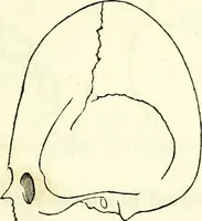 An illustration from Crania americana or, A comparative view of the skulls of various aboriginal nations of North and South America : to which is prefixed an essay on the varities of the human species / by Samuel George Morton. (1839)