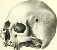 An illustration from Crania americana or, A comparative view of the skulls of various aboriginal nations of North and South America : to which is prefixed an essay on the varities of the human species / by Samuel George Morton. (1839)