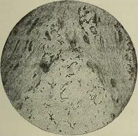 An illustration from A treatise on diseases of the skin with special reference to their diagnosis and treatment : including an analysis of 12,000 consecutive cases / Thomas McCall Anderson. (1894)