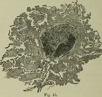 An illustration from A treatise on diseases of the skin with special reference to their diagnosis and treatment : including an analysis of 12,000 consecutive cases / Thomas McCall Anderson. (1894)