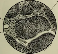 An illustration from A treatise on diseases of the skin with special reference to their diagnosis and treatment : including an analysis of 12,000 consecutive cases / Thomas McCall Anderson. (1894)