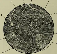 An illustration from A treatise on diseases of the skin with special reference to their diagnosis and treatment : including an analysis of 12,000 consecutive cases / Thomas McCall Anderson. (1894)