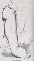An illustration from A treatise on diseases of the skin with special reference to their diagnosis and treatment : including an analysis of 12,000 consecutive cases / Thomas McCall Anderson. (1894)