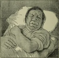 An illustration from A treatise on diseases of the skin with special reference to their diagnosis and treatment : including an analysis of 12,000 consecutive cases / Thomas McCall Anderson. (1894)