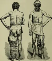 An illustration from A treatise on diseases of the skin with special reference to their diagnosis and treatment : including an analysis of 12,000 consecutive cases / Thomas McCall Anderson. (1894)