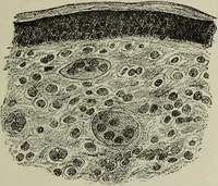 An illustration from A treatise on diseases of the skin with special reference to their diagnosis and treatment : including an analysis of 12,000 consecutive cases / Thomas McCall Anderson. (1894)