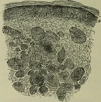 An illustration from A treatise on diseases of the skin with special reference to their diagnosis and treatment : including an analysis of 12,000 consecutive cases / Thomas McCall Anderson. (1894)