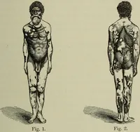 An illustration from A treatise on diseases of the skin with special reference to their diagnosis and treatment : including an analysis of 12,000 consecutive cases / Thomas McCall Anderson. (1894)