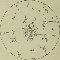 An illustration from A treatise on diseases of the skin with special reference to their diagnosis and treatment : including an analysis of 12,000 consecutive cases / Thomas McCall Anderson. (1894)