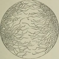 An illustration from A treatise on diseases of the skin with special reference to their diagnosis and treatment : including an analysis of 12,000 consecutive cases / Thomas McCall Anderson. (1894)