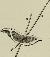 An illustration from A treatise on diseases of the skin with special reference to their diagnosis and treatment : including an analysis of 12,000 consecutive cases / Thomas McCall Anderson. (1894)