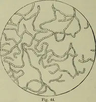 An illustration from A treatise on diseases of the skin with special reference to their diagnosis and treatment : including an analysis of 12,000 consecutive cases / Thomas McCall Anderson. (1894)
