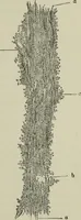 An illustration from A treatise on diseases of the skin with special reference to their diagnosis and treatment : including an analysis of 12,000 consecutive cases / Thomas McCall Anderson. (1894)