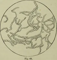 An illustration from A treatise on diseases of the skin with special reference to their diagnosis and treatment : including an analysis of 12,000 consecutive cases / Thomas McCall Anderson. (1894)
