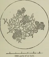 An illustration from A treatise on diseases of the skin with special reference to their diagnosis and treatment : including an analysis of 12,000 consecutive cases / Thomas McCall Anderson. (1894)