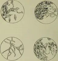 An illustration from A treatise on diseases of the skin with special reference to their diagnosis and treatment : including an analysis of 12,000 consecutive cases / Thomas McCall Anderson. (1894)