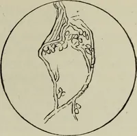 An illustration from A treatise on diseases of the skin with special reference to their diagnosis and treatment : including an analysis of 12,000 consecutive cases / Thomas McCall Anderson. (1894)