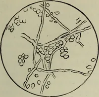 An illustration from A treatise on diseases of the skin with special reference to their diagnosis and treatment : including an analysis of 12,000 consecutive cases / Thomas McCall Anderson. (1894)