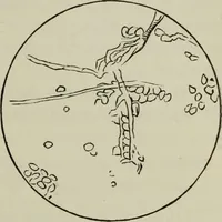 An illustration from A treatise on diseases of the skin with special reference to their diagnosis and treatment : including an analysis of 12,000 consecutive cases / Thomas McCall Anderson. (1894)