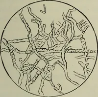 An illustration from A treatise on diseases of the skin with special reference to their diagnosis and treatment : including an analysis of 12,000 consecutive cases / Thomas McCall Anderson. (1894)