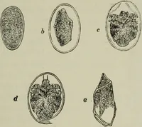 An illustration from A treatise on diseases of the skin with special reference to their diagnosis and treatment : including an analysis of 12,000 consecutive cases / Thomas McCall Anderson. (1894)