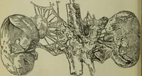 An illustration from A treatise on diseases of the skin with special reference to their diagnosis and treatment : including an analysis of 12,000 consecutive cases / Thomas McCall Anderson. (1894)