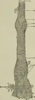 An illustration from A treatise on diseases of the skin with special reference to their diagnosis and treatment : including an analysis of 12,000 consecutive cases / Thomas McCall Anderson. (1894)