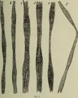 An illustration from A treatise on diseases of the skin with special reference to their diagnosis and treatment : including an analysis of 12,000 consecutive cases / Thomas McCall Anderson. (1894)
