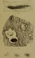 An illustration from La goutte : sa nature et son traitement / Dr W. Ebstein ... ; traduction de Dr E. Chambard ... ; introduction du Professeur Charcot ... ouvrage orné de 12 chromolithographies. (1887)
