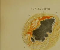 An illustration from La goutte : sa nature et son traitement / Dr W. Ebstein ... ; traduction de Dr E. Chambard ... ; introduction du Professeur Charcot ... ouvrage orné de 12 chromolithographies. (1887)