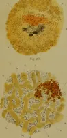 An illustration from La goutte : sa nature et son traitement / Dr W. Ebstein ... ; traduction de Dr E. Chambard ... ; introduction du Professeur Charcot ... ouvrage orné de 12 chromolithographies. (1887)