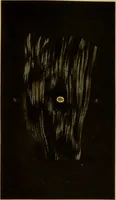 An illustration from La goutte : sa nature et son traitement / Dr W. Ebstein ... ; traduction de Dr E. Chambard ... ; introduction du Professeur Charcot ... ouvrage orné de 12 chromolithographies. (1887)