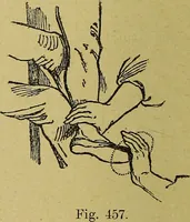 An illustration from La nuova medicina natural : trattato d'insegnamento e di consultazione sul metodo di curare e di guarire le malattie seguendo le leggi di natura / di F.E. Bilz. (1895)