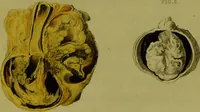 An illustration from A treatise on some practical points relating to the diseases of the eye / by the late John Cunningham Saunders; to which is added, a short account of the author's life, and his method of curing the congenital cataract, by his friend and colleague, J. R. Farre. The whole illustrated by colour engravings. (1811)