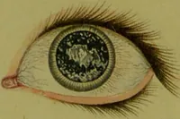 An illustration from A treatise on some practical points relating to the diseases of the eye / by the late John Cunningham Saunders; to which is added, a short account of the author's life, and his method of curing the congenital cataract, by his friend and colleague, J. R. Farre. The whole illustrated by colour engravings. (1811)