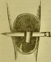 Picture 164 of 165 from A system of practical and scientific physiognomy, or, How to read faces : being a manual of instruction in the knowledge of the human physiognomy and organism, embracing the discoveries of located signs of character in the body and face, as shown by the five natural divisions of the countenance. Volume 2 / by Mary Olmstead Stanton. (1890), leaf 657