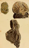 An illustration from Asthma : its varieties and complications, or, Researches into the pathology of disordered respiration; with remarks on the treatment applicable to each variety: illustrated by cases, and plates coloured from nature. Also, a succinct treatise on the principal diseases of the heart ... / by Francis Hopkins Ramadge. (1847)